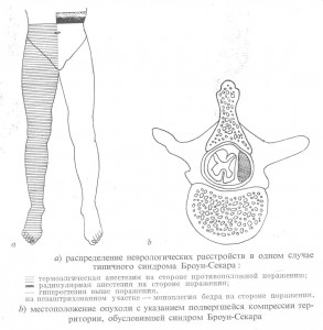 Броун-Секара синдром_классический вариант
