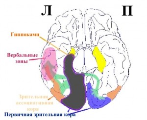 Дежерина теменно-затылочный синдром_схема