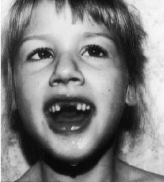 worster-draught syndrome_girl 6yo_face1